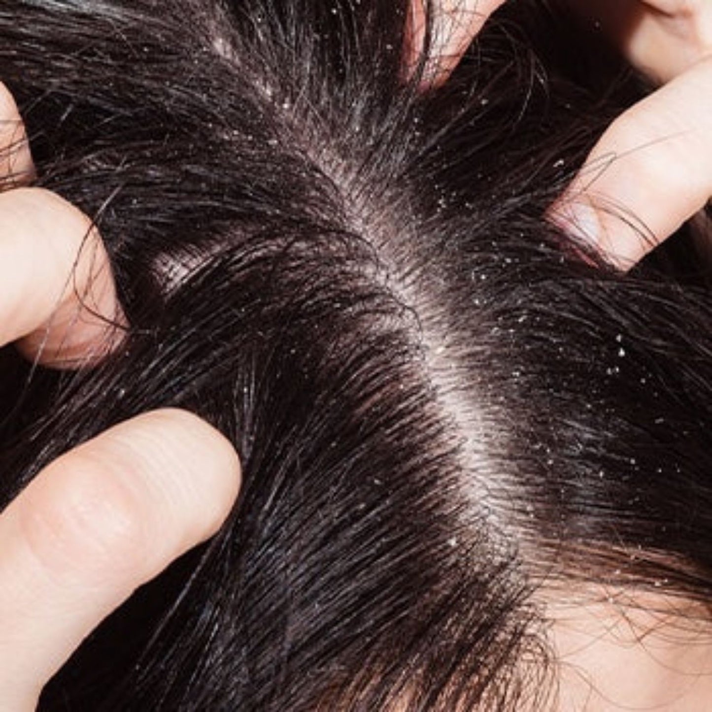 Patrichory Anti-Dandruff Dark Relief Shampoo Bar For Flaky or Itchy Scalps